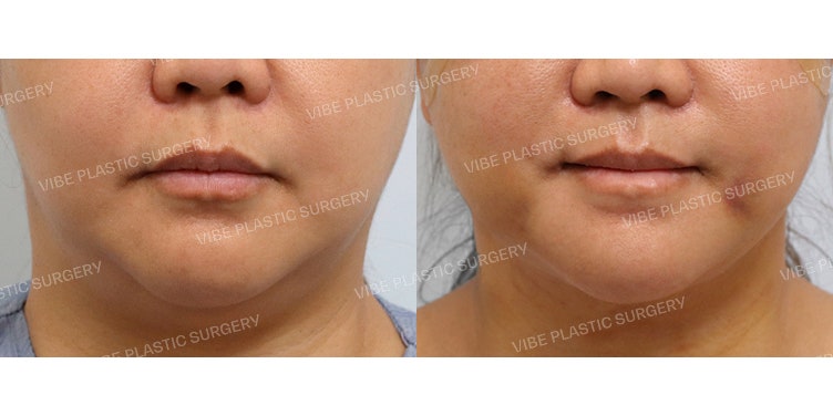 Double Chin Muscle Tying (Platysmaplasty)