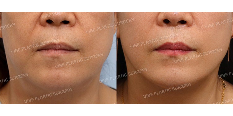 ศัลยกรรมดึงคอ (เย็บกล้ามเนื้อใต้คาง) & ดึงหน้า (Facelift) !