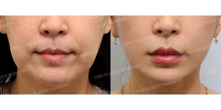 Achieving a Slimmer Face Shape with a Full Facelift!