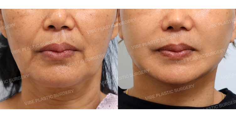 ผลลัพธ์สุดปังจากการดึงหน้าและดึงคอ (Face & Neck Lift)!