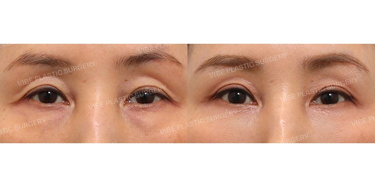 تجميل العيون في منتصف العمر: كيف تصبحين جميلة بشكل طبيعي دون أثر واضح للجراحة!
