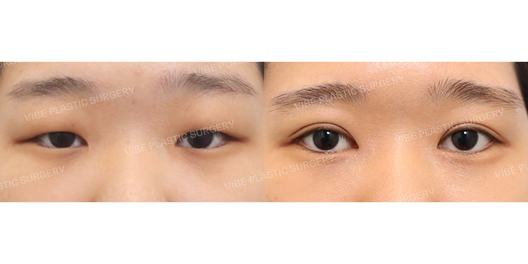 Khắc phục đôi mắt dày và lờ đờ !