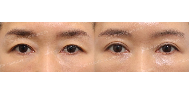 Nâng cung mày dưới và Nhấn mí tự nhiên!