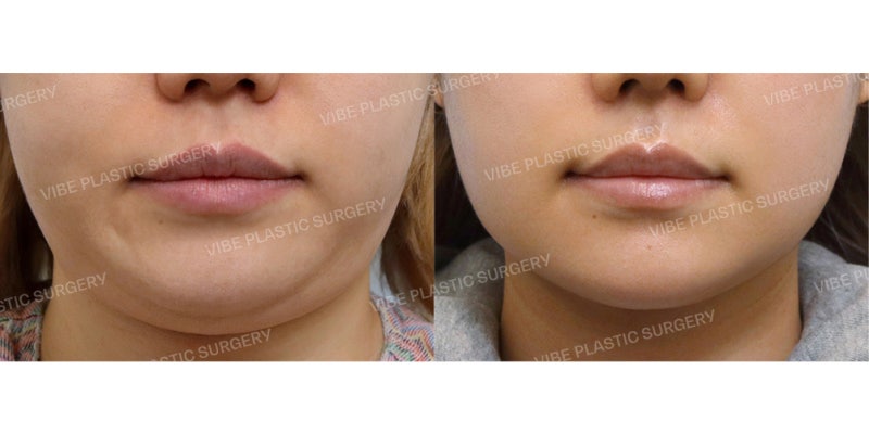 Achieve a Slim Face with Buccal Fat Removal and Liposuction!
