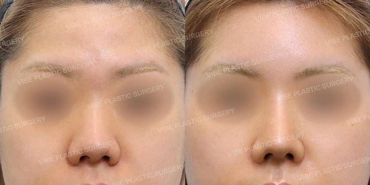 The Line from Forehead to Nose is Truly Essential! :D