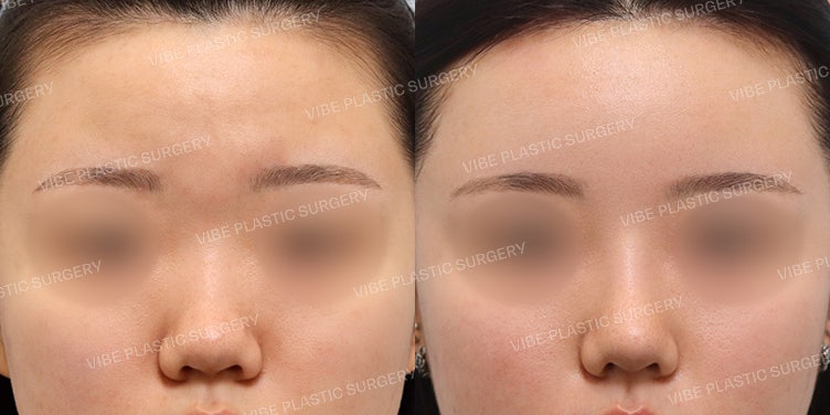Transformasi Luar Biasa Melalui Cangkok Lemak dan Operasi Hidung!