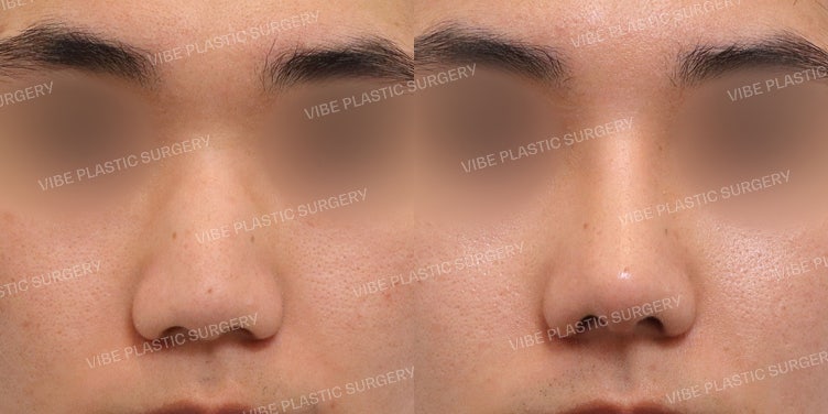 Transformasi Penampilan Berhasil dengan Operasi Hidung Lebar (Bulbous Nose) Pria!