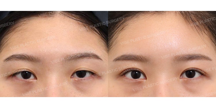 Hoàn thiện diện mạo tươi tắn nhờ phẫu thuật lại chỉnh hình cơ nâng mi! (+ Cấy mỡ trán)