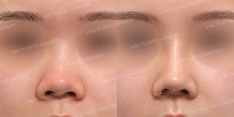 The Transformation of a Low and Short Bulbous Nose!