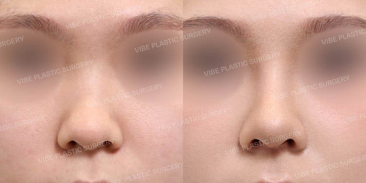 Menciptakan Garis Hidung Sempurna dengan Koreksi Hidung Lebar (Bulbous Nose)!