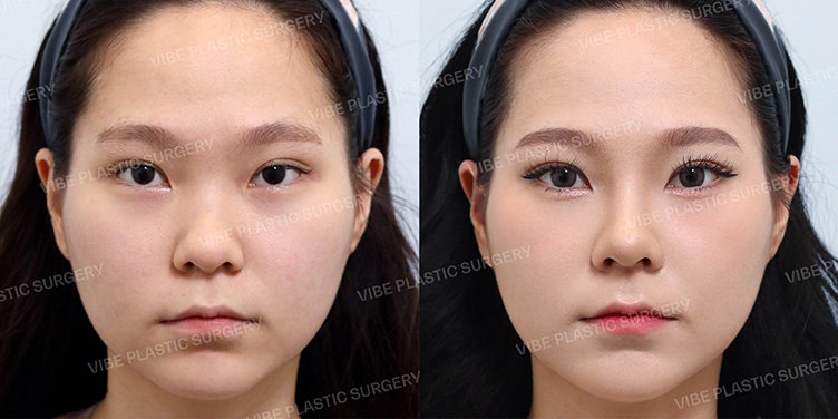ฉันก็มีจมูกแบบ ‘วินเทอร์’ ได้เหรอ? ได้แน่นอน !!