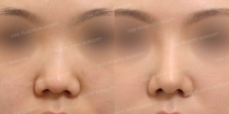 ศัลยกรรมจมูกสั้นที่ Vibe Plastic Surgery :D