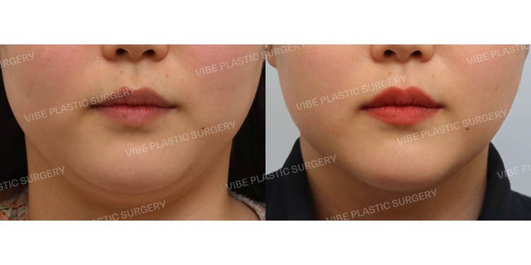 สัมผัสผลลัพธ์ของการดูดไขมันด้วยคลื่นเสียงความถี่สูง LipoSound! ที่ VIBE Plastic Surgery :)