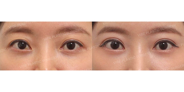 Hoàn thiện đôi mắt sắc nét và cân đối bằng phẫu thuật chỉnh hình sụp mí không xâm lấn (tái phẫu thuật)!
