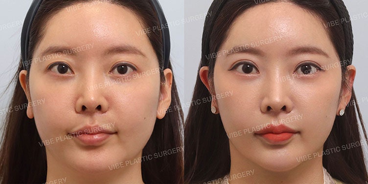 Achieving a Defined Look with Ptosis Revision and Facial Liposuction!