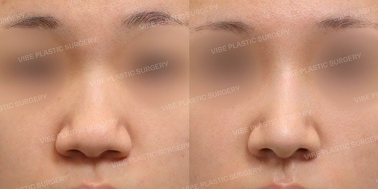 Can a Bulbous Nose Change This Much?! Bulbous Nose Rhinoplasty at VIBE Plastic Surgery :)