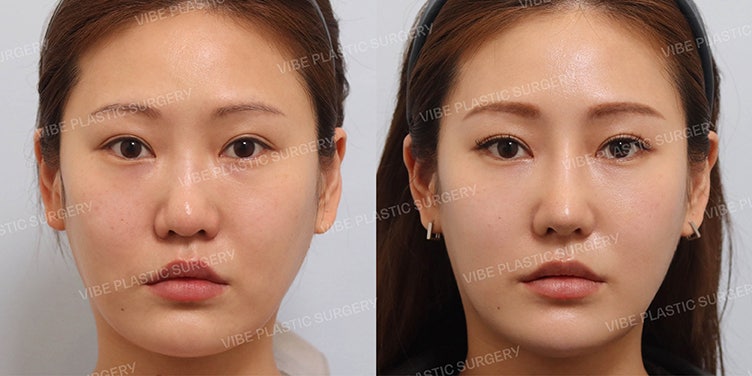 قصة واقعية 10: تجميل الأنف الطويل والأنف العريض مع تصحيح الزاوية الأنفية الشفوية
