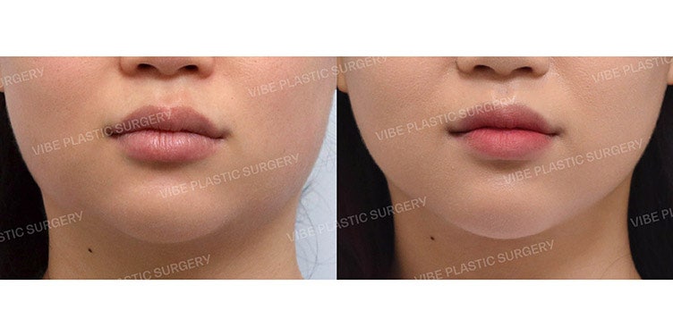 ดูดไขมันด้วยคลื่นอัลตราซาวด์?! ต้องที่ VIBE Plastic Surgery!