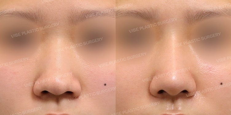 Operasi Hidung Pesek (Bulbous Nose) di Vibe Plastic Surgery!