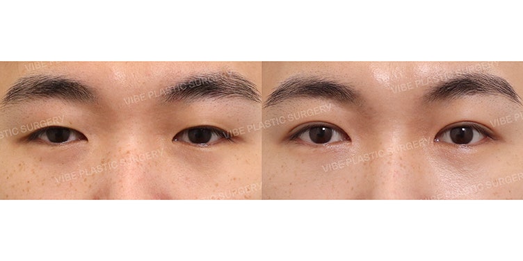 通过男性眼提肌矫正打造清晰干练的印象!