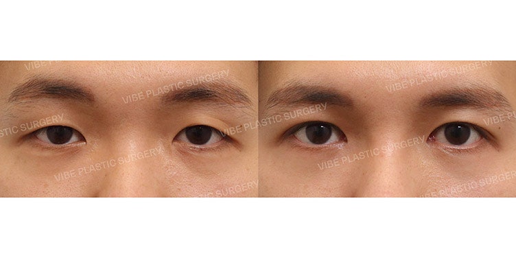 ศัลยกรรมปรับกล้ามเนื้อตาสำหรับผู้ชาย ต้องที่ VIBE Plastic Surgery!