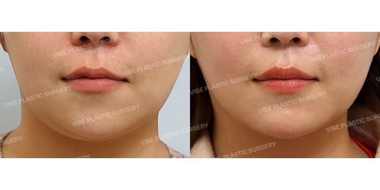 Liposuction V-Line?! Di Vibe Plastic Surgery!