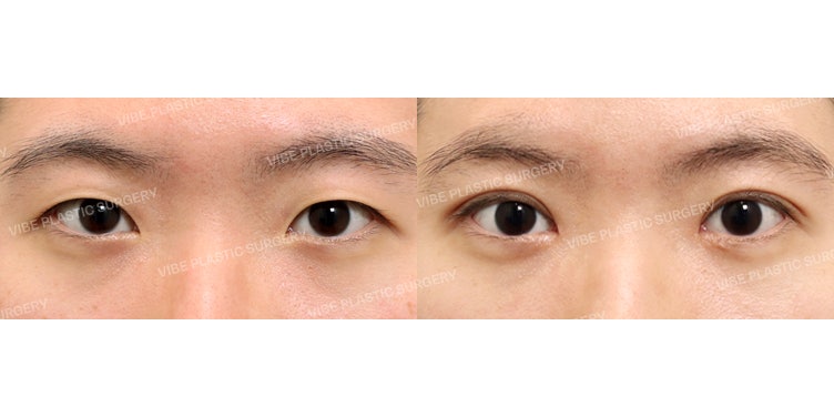 สร้างภาพลักษณ์ที่สดใสด้วยเทคนิคเย็บจุดธรรมชาติ (Natural Adhesion)!