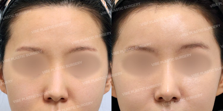 The Line from Forehead to Nose is Crucial, Isn’t It?!