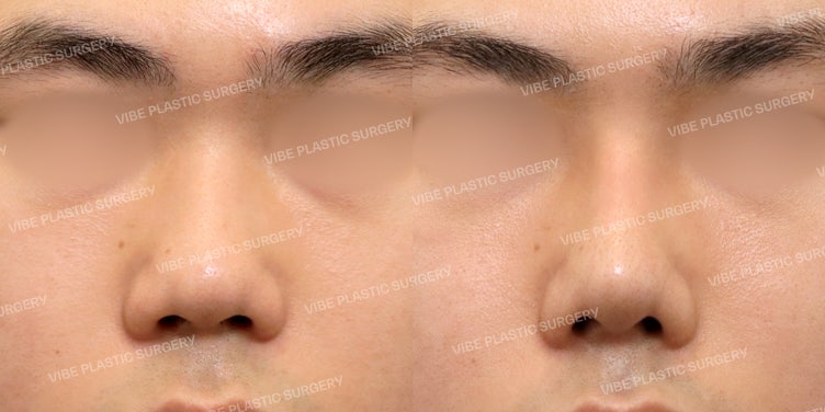 تحسين التهاب الأنف مع الحصول على أنف رجالي أنيق من خلال عملية تجميل الأنف الوظيفية!