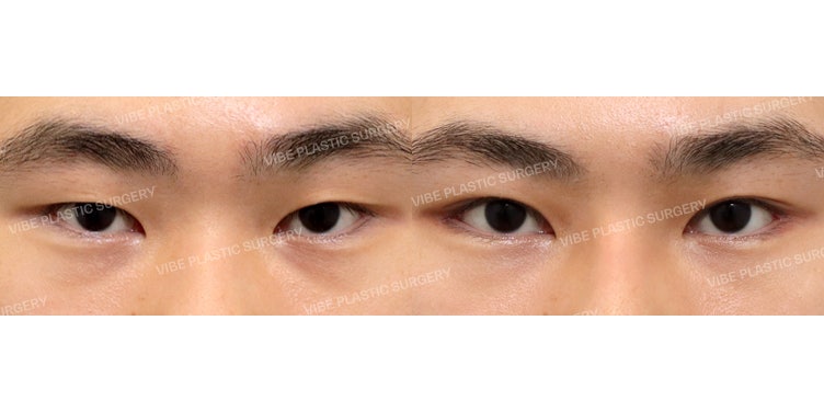 Male Non-Incisional Ptosis Correction and Dual Canthoplasty: A Complete Image Transformation