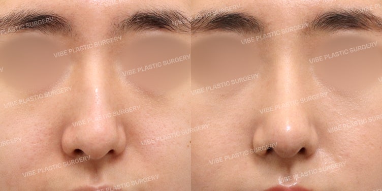 تحول مذهل من خلال عملية تجميل الأنف بدون غرسات صناعية! اختبر الفرق في عيادة فايب للتجميل ~!!