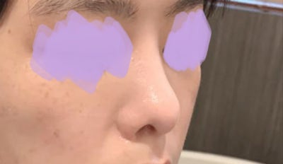 แก้ไขจมูกมังกรและแกนจมูกหย่อนคล้อย