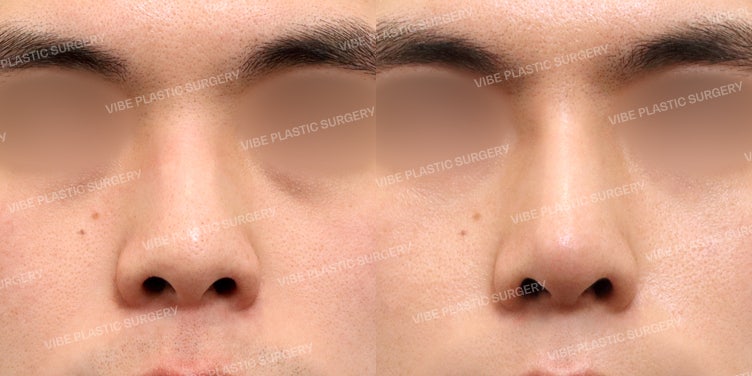 Operasi Hidung Pendek Pria di Vibe Plastic Surgery! (feat. BBU TV)