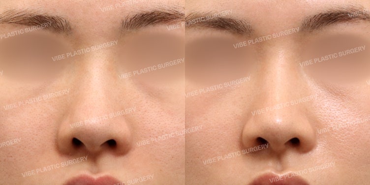 Lubang Hidung Asimetris?! Lubang Hidung Terjepit?! Atasi dengan Alar Rim Lowering!