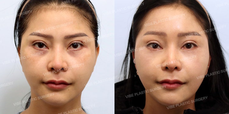 I want to improve my fierce impression ~ (The effects of Endoscopic Forehead Lift!)