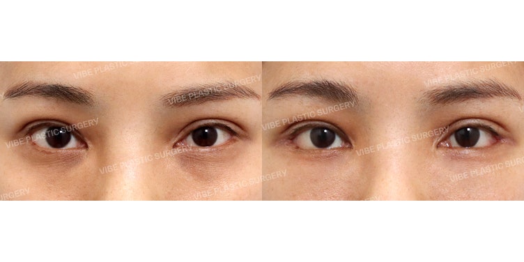 Lateral and Lower Canthoplasty with Under-Eye Fat Repositioning