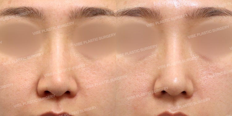 تجميل طرف الأنف بمظهر طبيعي وجذاب!