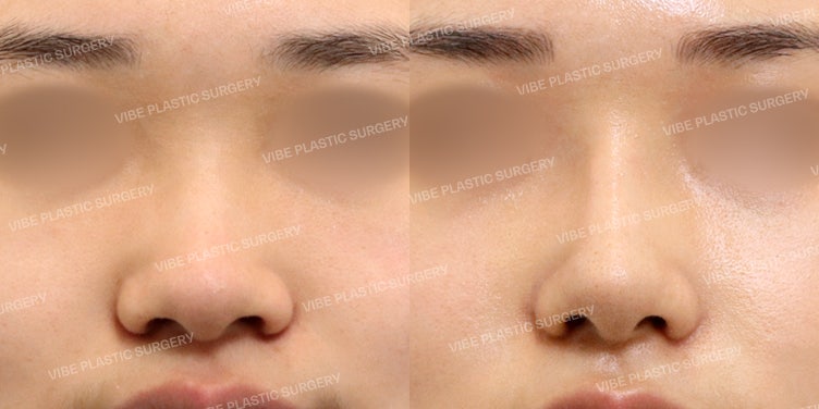Frontal Effect of Bulbous Nose Correction + Alar Reduction - Dr. Young Moon Yoo, VIBE Plastic Surgery (Wannabe: Actress Kim Yoo-jung's Nose)