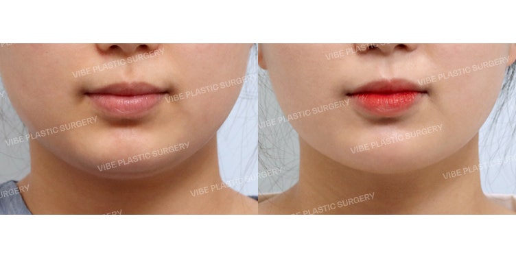 Melt the Fat Away!! Achieve a Slim V-Line with LipoSound Ultrasonic Liposuction!