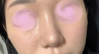 厚皮膚蒜頭鼻與長鼻二次手術案例