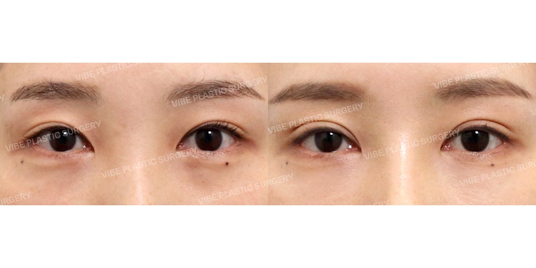 자연유착 재수술 로 선명한 인아웃 라인을 만들어요 ~!