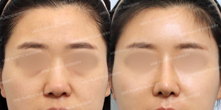 Elegant Straight-Semi-Basal Nose! You Can Have Kim Yoo-jung’s Nose Too!