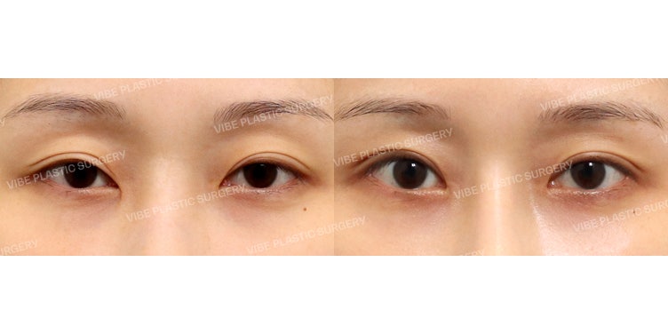 Tôi ghét đôi mắt xúc xích ㅠ Phẫu thuật lại mắt lần thứ 3 !