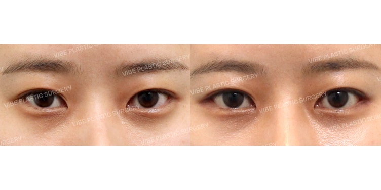 ศัลยกรรมแก้หางตาและเปิดหางตาด้านล่างที่ VIBE Plastic Surgery !!