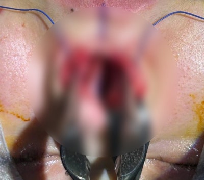 يمكن تحسين التهاب الأنف مع تجميل الأنف المائل!!