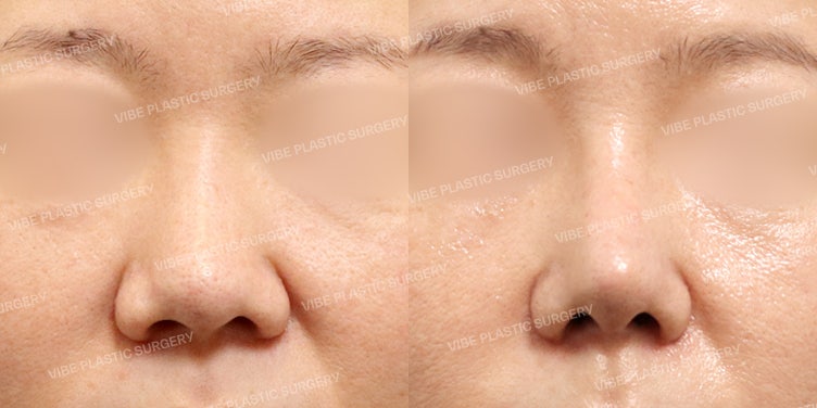 ไหมร้อยจมูก Hiko ไม่ช่วยแก้จมูกชมพู่! แก้ไขจมูกชมพู่ที่หนามากให้เรียวสวยที่ Vibe Plastic Surgery!!