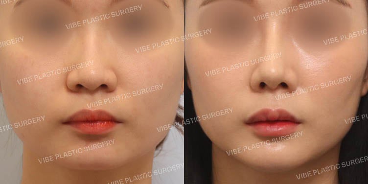 Correcting a Protruding Mouth with Rhinoplasty? Achieve it at VIBE Plastic Surgery!