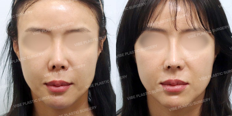 Achieving a Sophisticated Nose Line with Short Nose Revision and Alar Retraction! :D