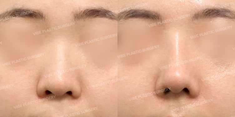 ทรงจมูกสโลปปลายพุ่งที่ดูเป็นธรรมชาติและสวยเฉี่ยว ต้องที่ VIBE Plastic Surgery!