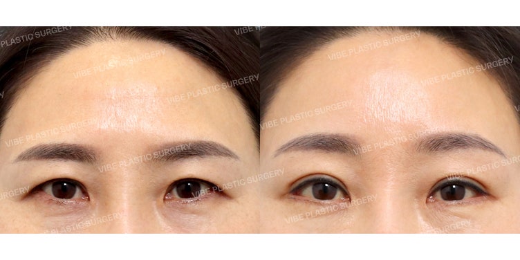 Tampak 10 Tahun Lebih Muda dengan Brow Lift (Endoscopic Forehead Lift) :D